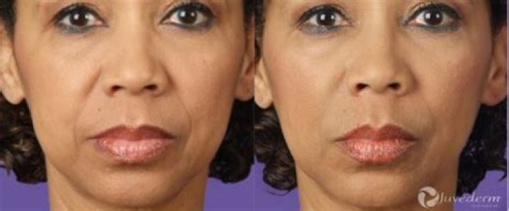 How long does it take juvederm to settle?